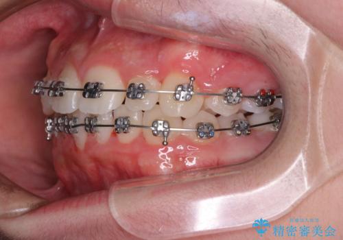 中学生のワイヤー矯正 クロスバイトを短期間で改善の治療中