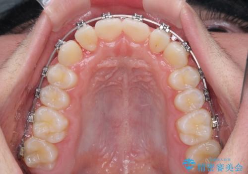中学生のワイヤー矯正 クロスバイトを短期間で改善の治療中