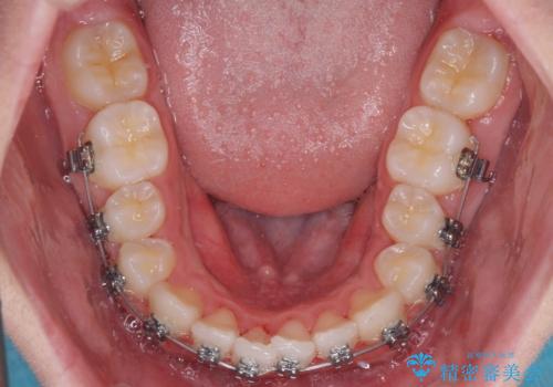 中学生のワイヤー矯正 クロスバイトを短期間で改善の治療中