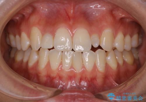 前歯のセラミックを作る前にホワイトニングの症例 治療前