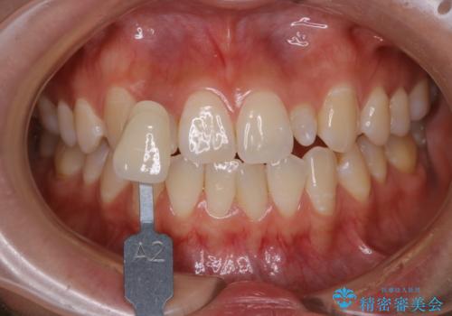 前歯のセラミックを作る前にホワイトニングの治療前