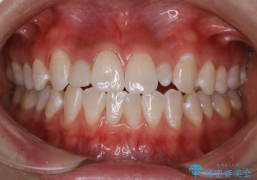 前歯のセラミックを作る前にホワイトニングの治療後