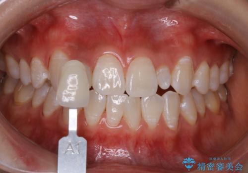 前歯のセラミックを作る前にホワイトニングの治療後