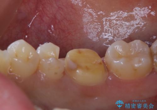 銀歯を白くしたい:適合の良い被せ物で長期間安心して使える歯にの治療中
