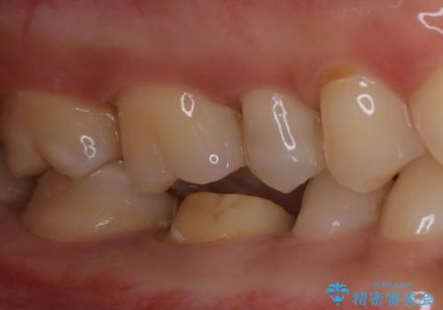 銀歯を白くしたい:適合の良い被せ物で長期間安心して使える歯にの治療中