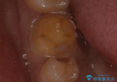 銀歯を白くしたい:適合の良い被せ物で長期間安心して使える歯にの治療中