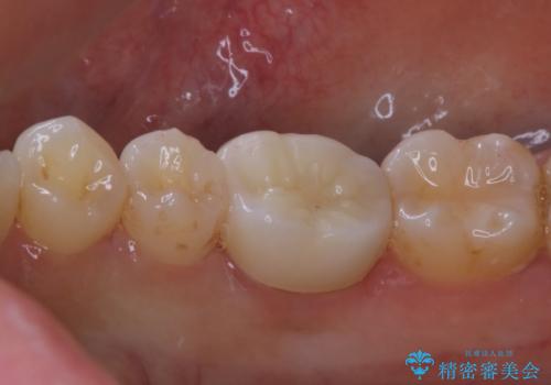 銀歯を白くしたい:適合の良い被せ物で長期間安心して使える歯にの治療後