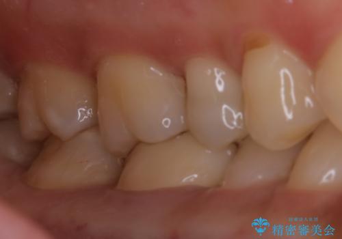 銀歯を白くしたい:適合の良い被せ物で長期間安心して使える歯に