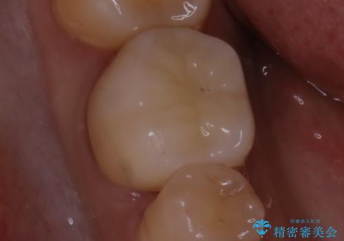 銀歯を白くしたい:適合の良い被せ物で長期間安心して使える歯にの治療後