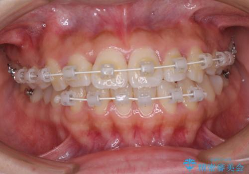 軽微な歯列不正をワイヤー矯正で整えるの治療中