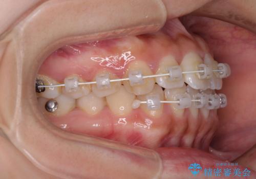 軽微な歯列不正をワイヤー矯正で整えるの治療中