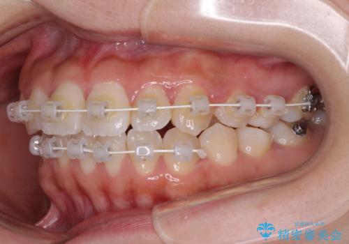 軽微な歯列不正をワイヤー矯正で整えるの治療中