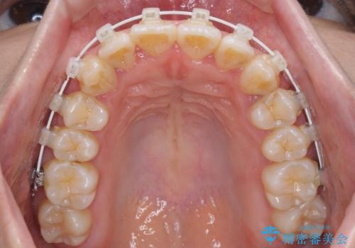 軽微な歯列不正をワイヤー矯正で整えるの治療中