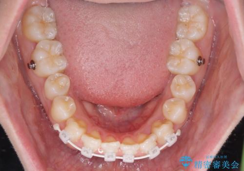 軽微な歯列不正をワイヤー矯正で整えるの治療中