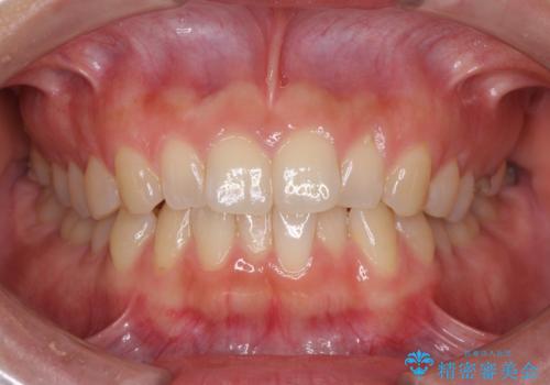 インプラントによる補綴治療とインビザライン矯正の症例 治療前