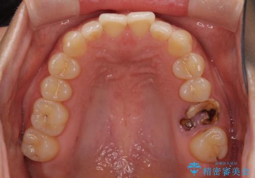 インプラントによる補綴治療とインビザライン矯正の治療前