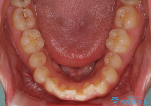 インプラントによる補綴治療とインビザライン矯正の治療前