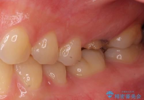 インプラントによる補綴治療とインビザライン矯正の治療前