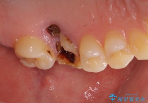 インプラントによる補綴治療とインビザライン矯正の治療前