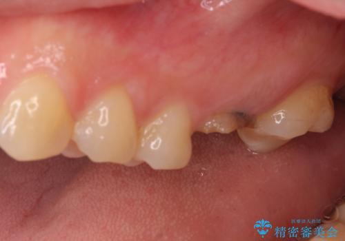 インプラントによる補綴治療とインビザライン矯正の治療前