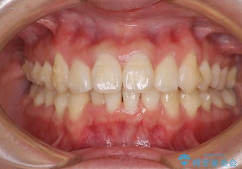 上下前歯の叢生をインビザラインできれいにの治療中