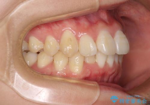 上下前歯の叢生をインビザラインできれいにの治療中