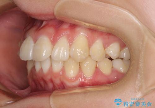 上下前歯の叢生をインビザラインできれいにの治療中