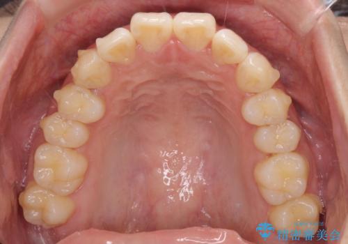上下前歯の叢生をインビザラインできれいにの治療中