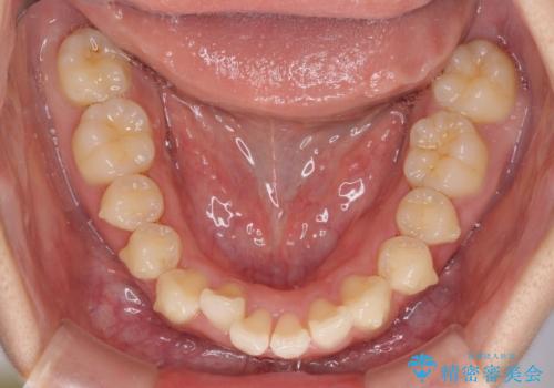 上下前歯の叢生をインビザラインできれいにの治療中