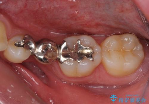 外れてしまった銀歯の詰め物 オールセラミックブリッジにて審美補綴の症例 治療前