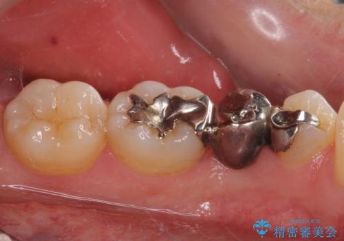 外れてしまった銀歯の詰め物 オールセラミックブリッジにて審美補綴の治療前