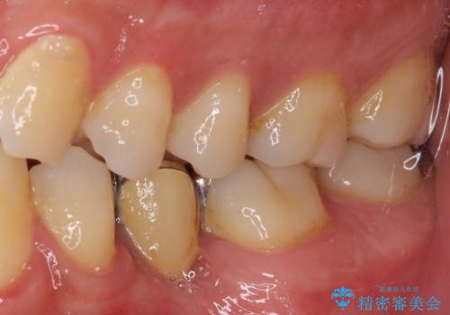 外れてしまった銀歯の詰め物 オールセラミックブリッジにて審美補綴の治療前