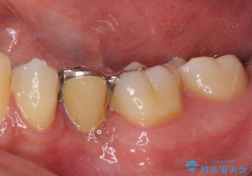 外れてしまった銀歯の詰め物 オールセラミックブリッジにて審美補綴の治療前