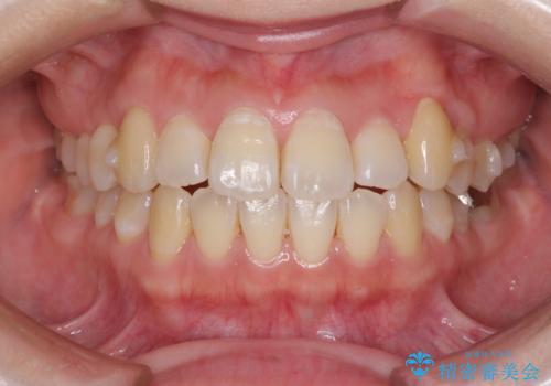 口元の突出感を改善　インビザラインによる非抜歯矯正の治療中