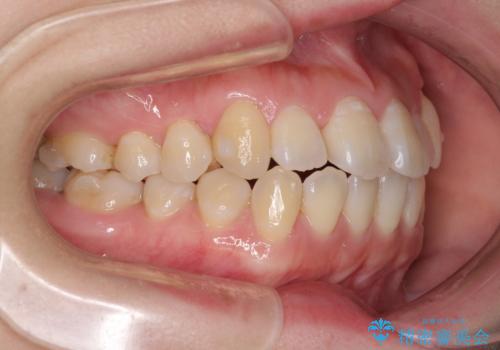 口元の突出感を改善　インビザラインによる非抜歯矯正の治療中