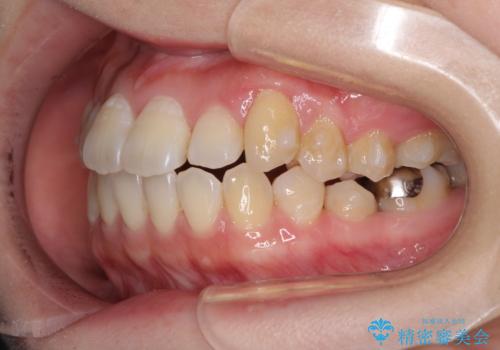 口元の突出感を改善 インビザラインによる非抜歯矯正の治療中