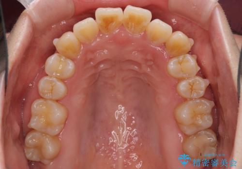 口元の突出感を改善 インビザラインによる非抜歯矯正の治療中