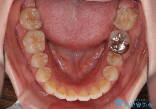 口元の突出感を改善 インビザラインによる非抜歯矯正の治療中