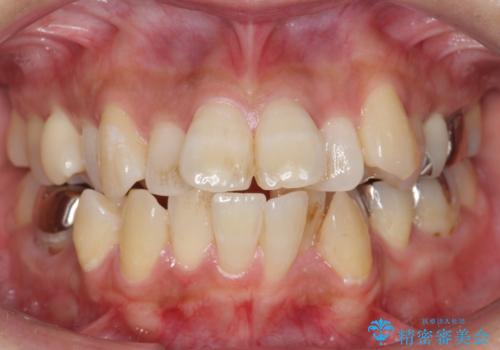 出っ歯 前歯のがたがた 口元を引っ込めたいの症例 治療前