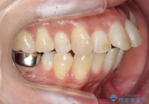 出っ歯　前歯のがたがた　口元を引っ込めたいの治療前
