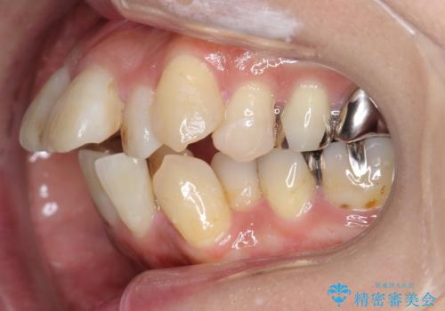 出っ歯　前歯のがたがた　口元を引っ込めたいの治療前