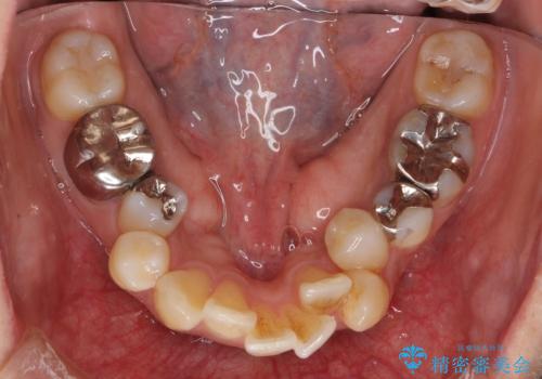 出っ歯 前歯のがたがた 口元を引っ込めたいの治療前