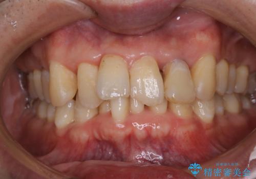 歯周病の治療前にまずはモチベーションUPにPMTCでステインの除去の治療前