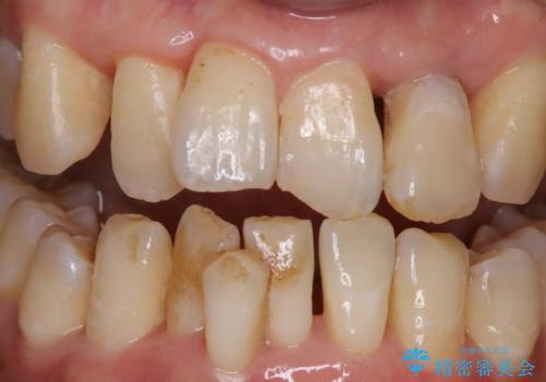 歯周病の治療前にまずはモチベーションUPにPMTCでステインの除去の症例 治療前