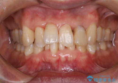 歯周病の治療前にまずはモチベーションUPにPMTCでステインの除去の治療後