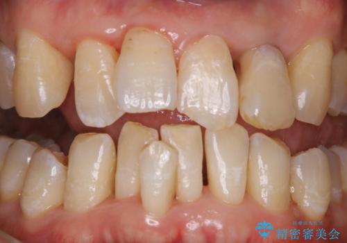 歯周病の治療前にまずはモチベーションUPにPMTCでステインの除去の症例 治療後