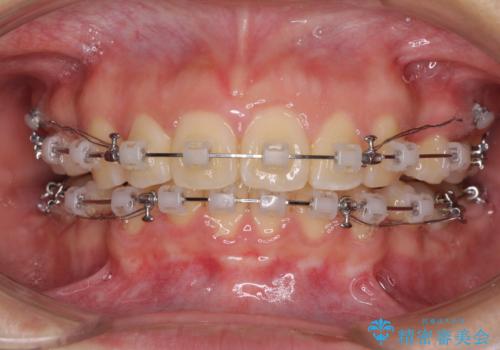 部分矯正で出っ歯になった 出っ歯改善の抜歯矯正の治療中