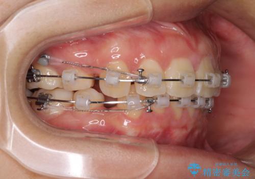 部分矯正で出っ歯になった　出っ歯改善の抜歯矯正の治療中