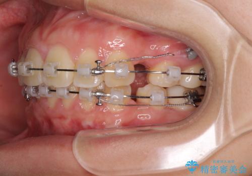 部分矯正で出っ歯になった 出っ歯改善の抜歯矯正の治療中
