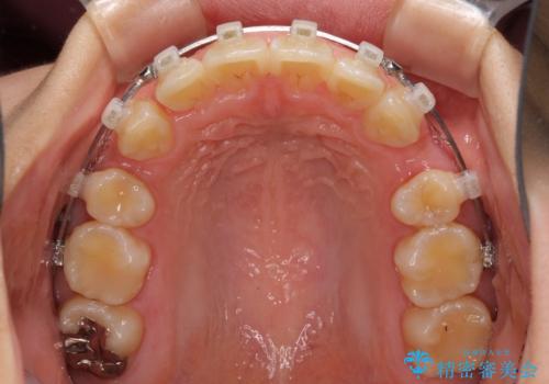 部分矯正で出っ歯になった　出っ歯改善の抜歯矯正の治療中